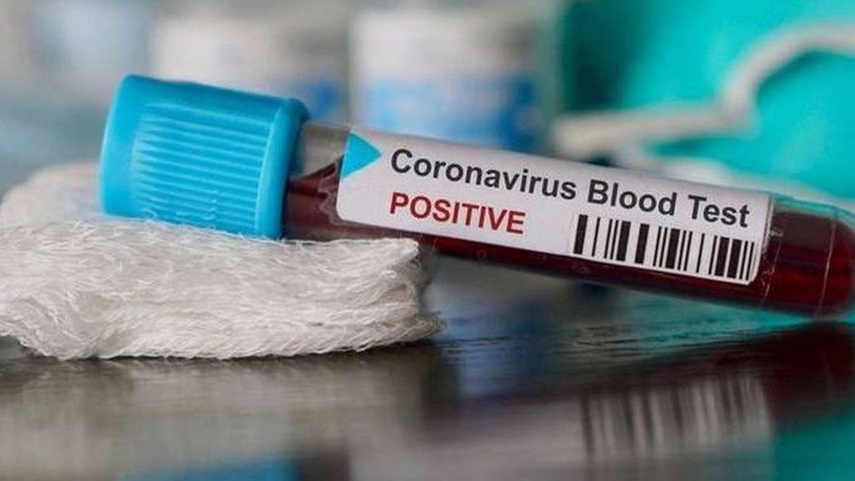 Echantillon de sang positif au Covid-19.
