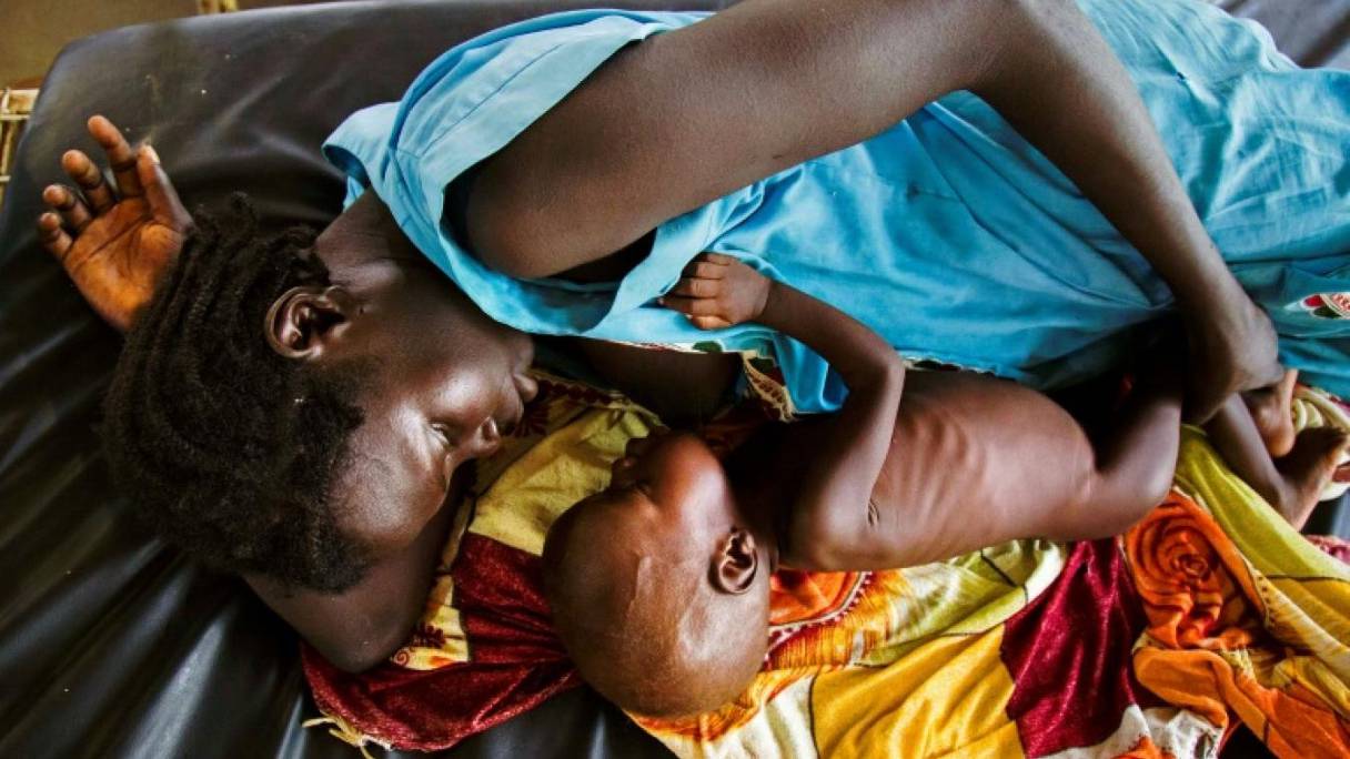Un enfant sous-alimenté dans un hôpital du Soudan du Sud. 
