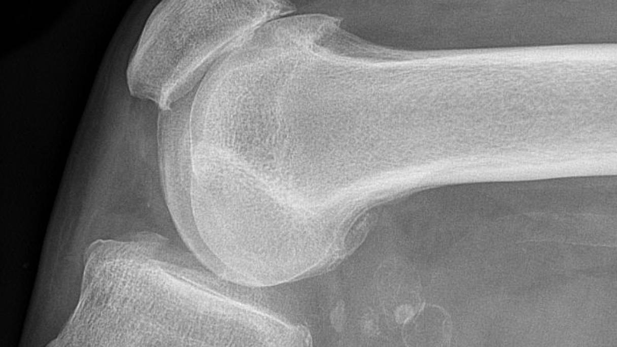 Radiographie d'une chondromatose synoviale, avec chondromes multiples dans un kyste de Baker: cas d’une gonarthrose.
