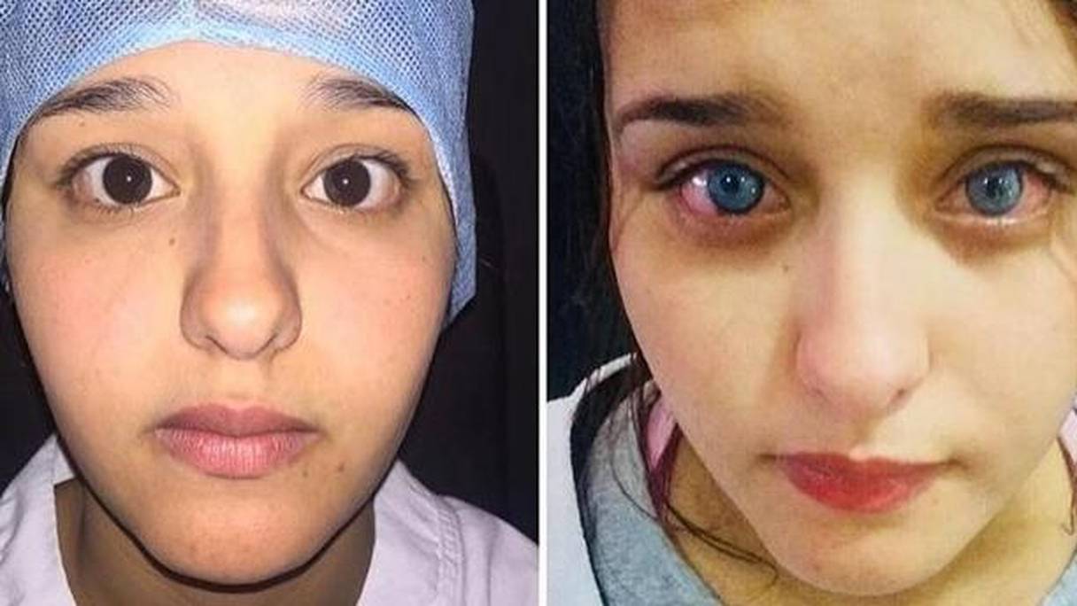 Première au Maroc: 18.000 dirhams pour changer la couleur de ses yeux |  le360.ma