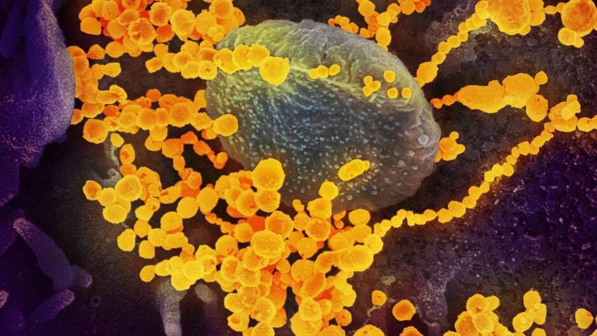 En jaune, des grappes de coronavirus SARS-CoV-2, responsables de la maladie du Covid-19, entourant une cellule humaine.
