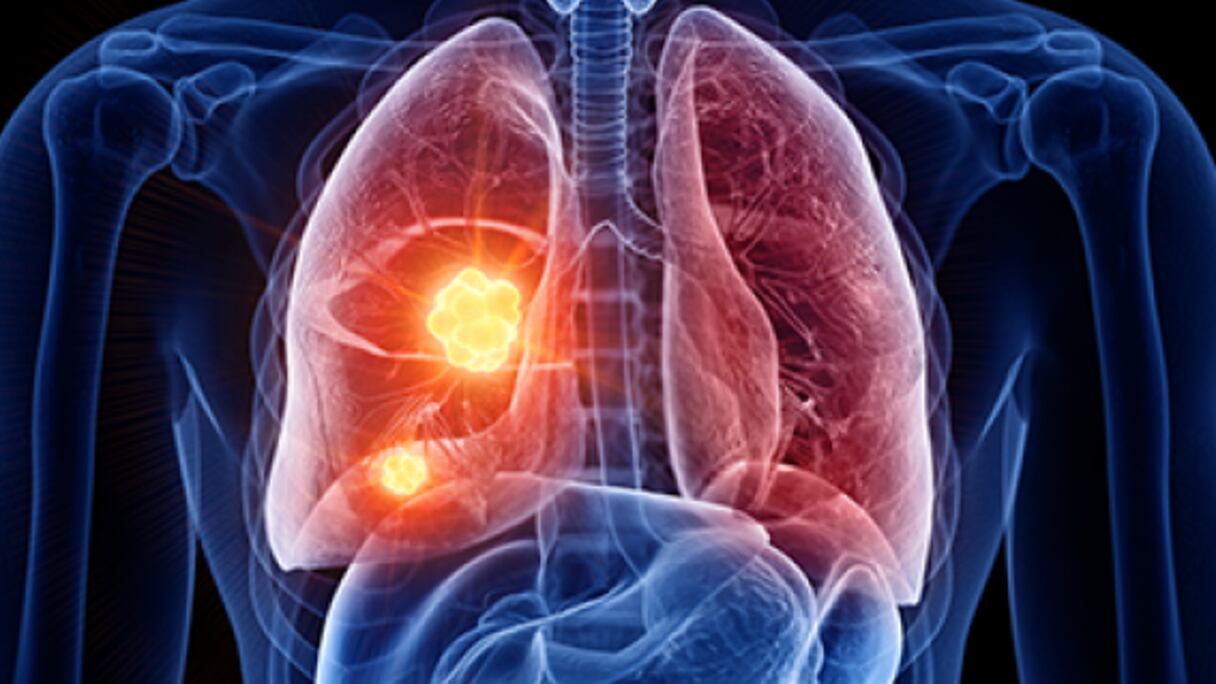 Des scientifiques d'un nouvel institut du cancer à l'Université de Cambridge étudient de nouvelles méthodes de détection du cancer à un stade très précoce.