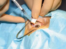 Une injection intravitreenne.