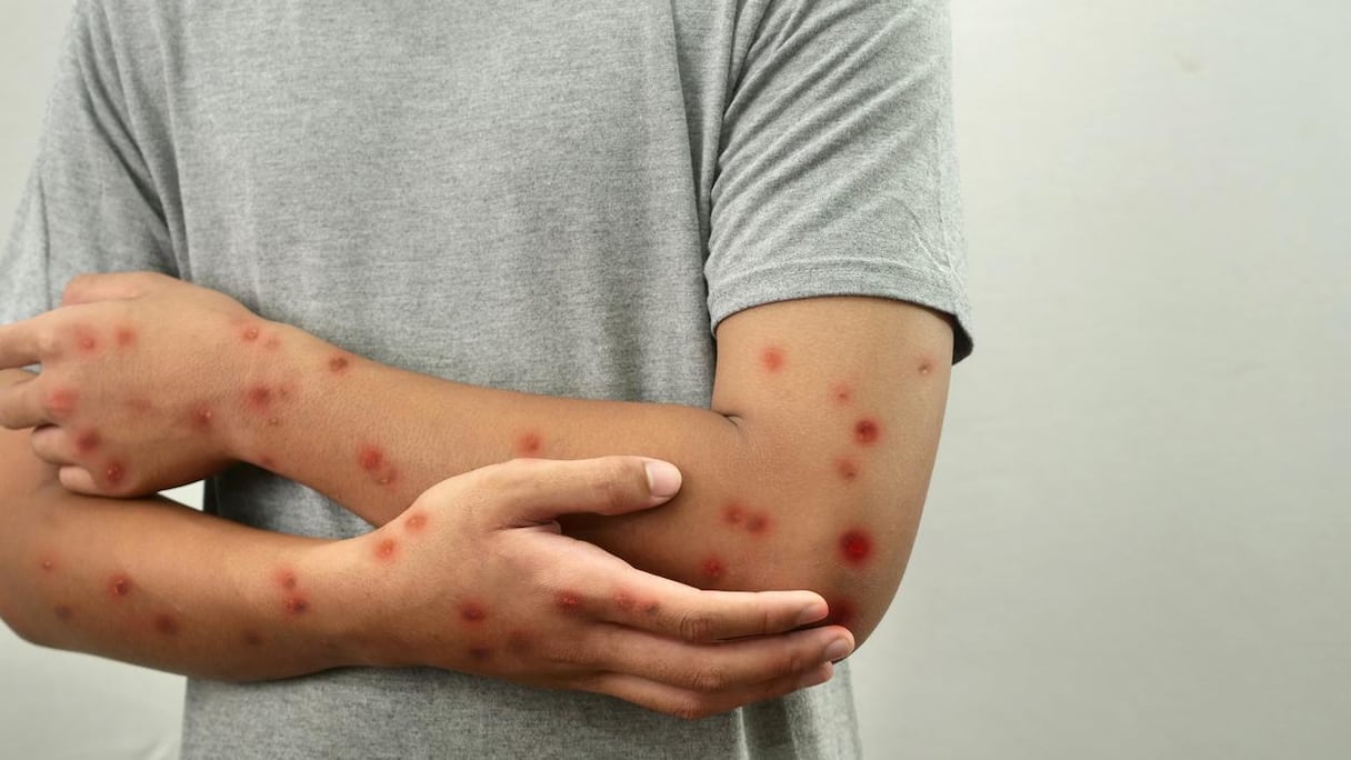Un premier cas de mpox a été détecté au Maroc, à Marrakech, a annoncé le ministère de la santé le 12 septembre.