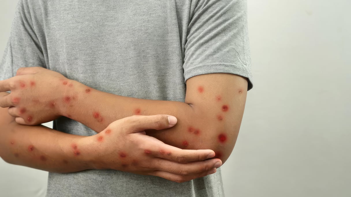 Mpox - Variole du singe