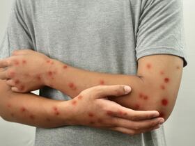 Mpox - Variole du singe