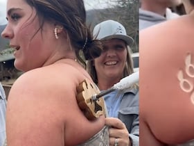 Les dermatologues mettent en garde contre les dangers du Freeze Branding, technique de marquage du bétail utilisée comme nouvelle technique de tatouage.