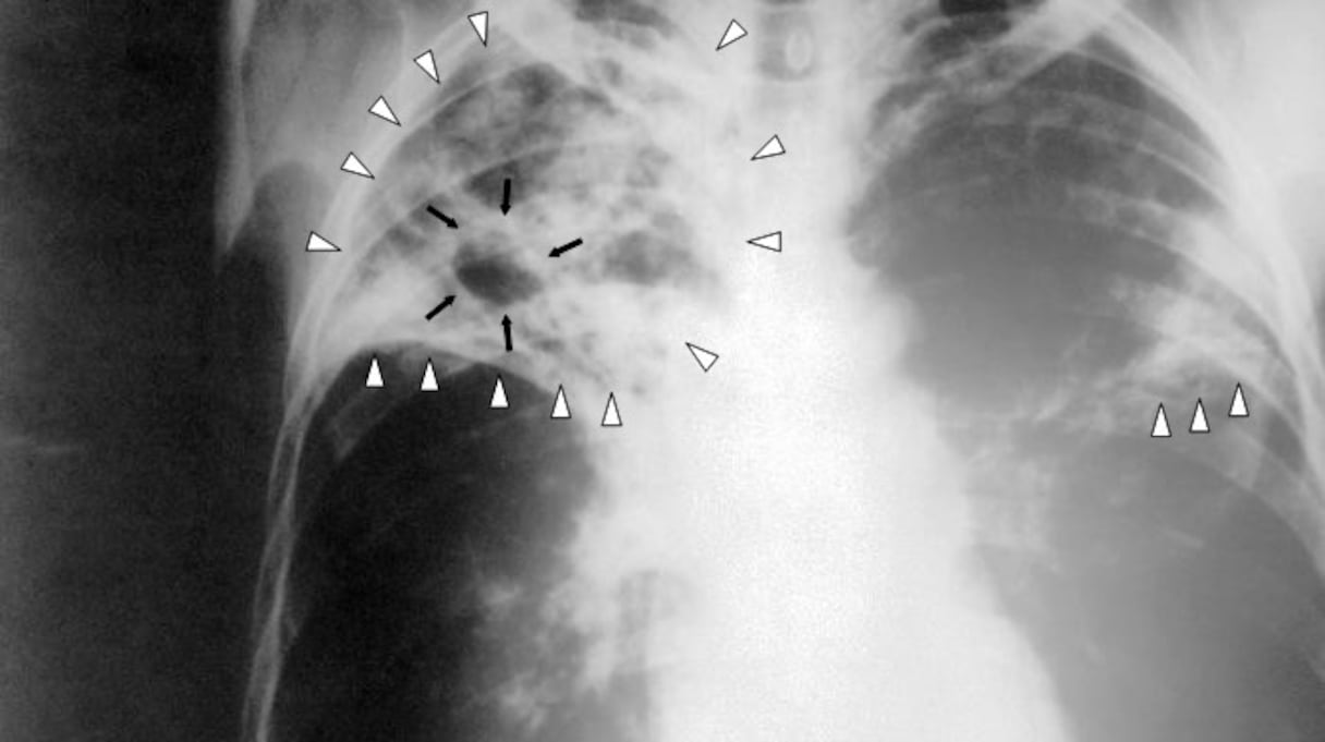 Radiographie thoracique d'un patient atteint d'une tuberculose à un stade avancé touchant ses poumons: présence de micro-nodules à prédominance supérieure (triangles blancs) ainsi que d'un caverne tuberculeux au niveau apical droit (flèches noires).
